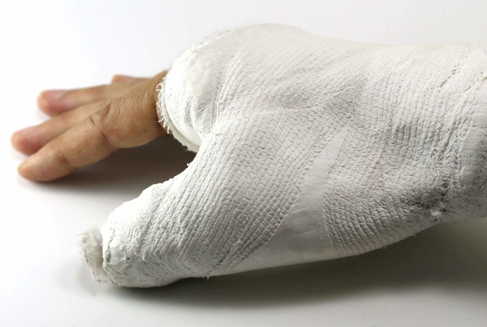 Burn Injuries 1 burn injury lawyers
