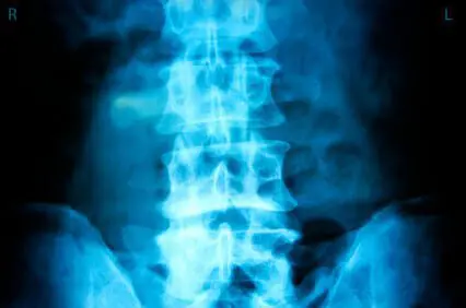 What Should I Bring to the Initial Consultation for My Spinal Injury Case? 1 What Should I Bring to the Initial Consultation for My Spinal Injury Case? iStock 000010083633XSmall