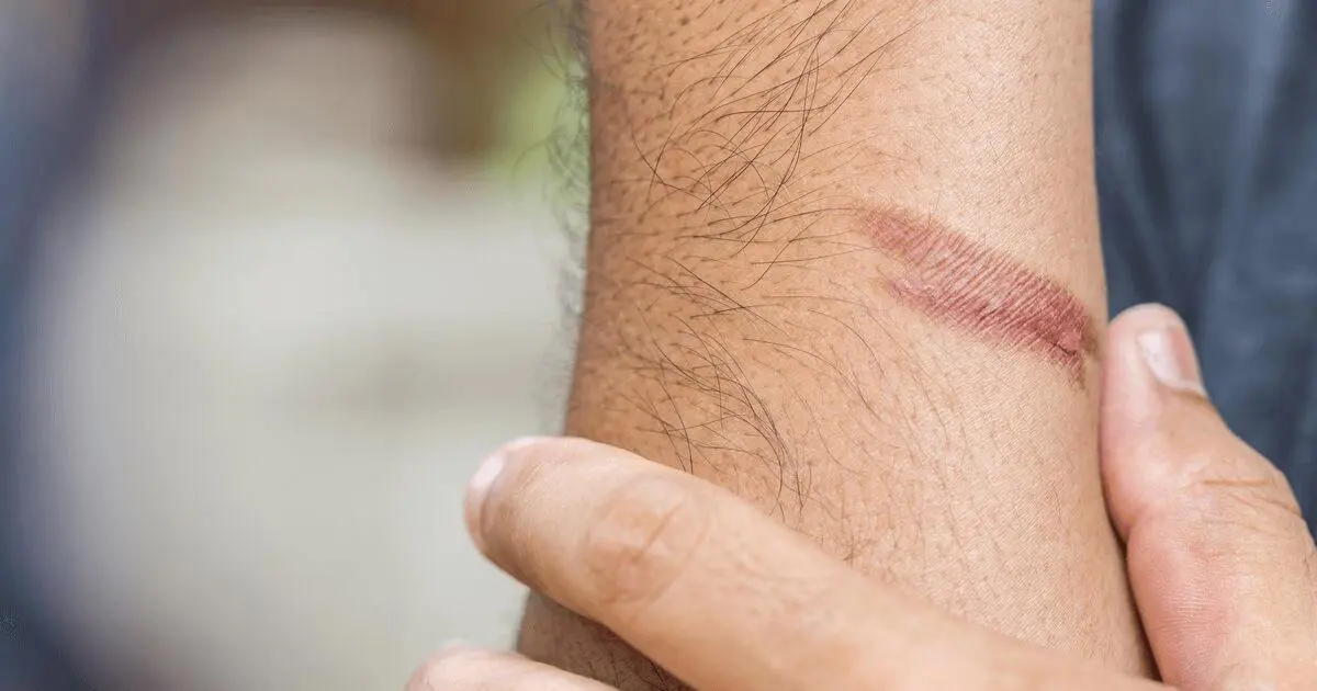 Barbeque Your Food, Not Yourself: Understanding Burn Risks 1 burn risks