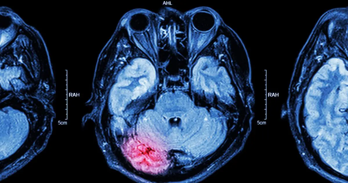 What’s the Difference Between an Anoxic vs. Hypoxic Brain Injury? 1 anoxic hypoxic brain injury