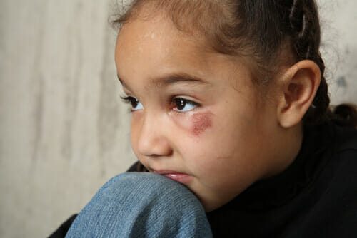 abused child with bruise under eye