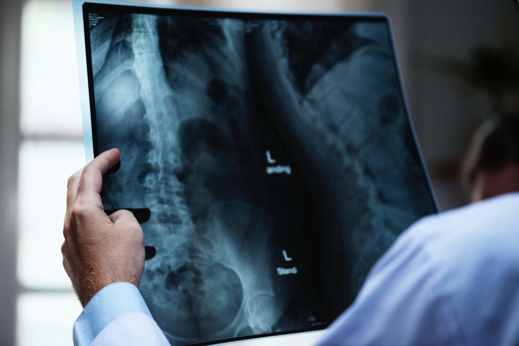 Doctor reading a spinal X-ray